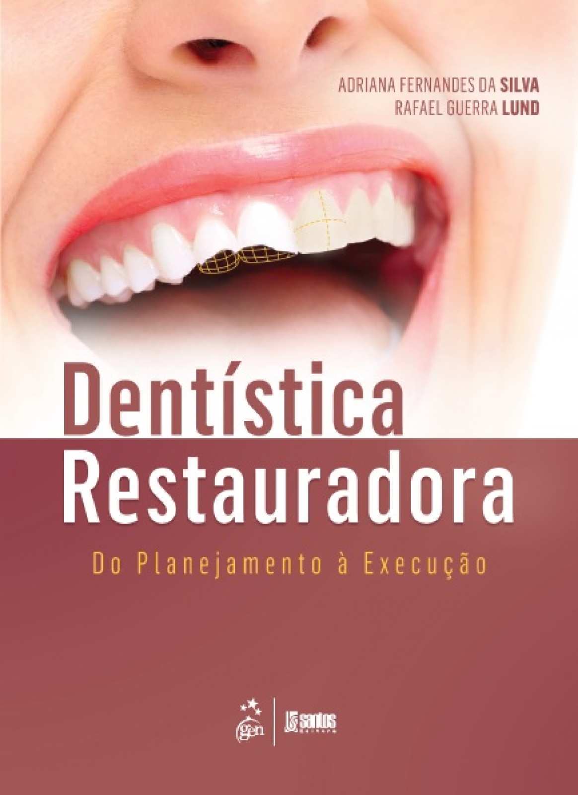 Dentística Restauradora - Do Planejamento À Execução