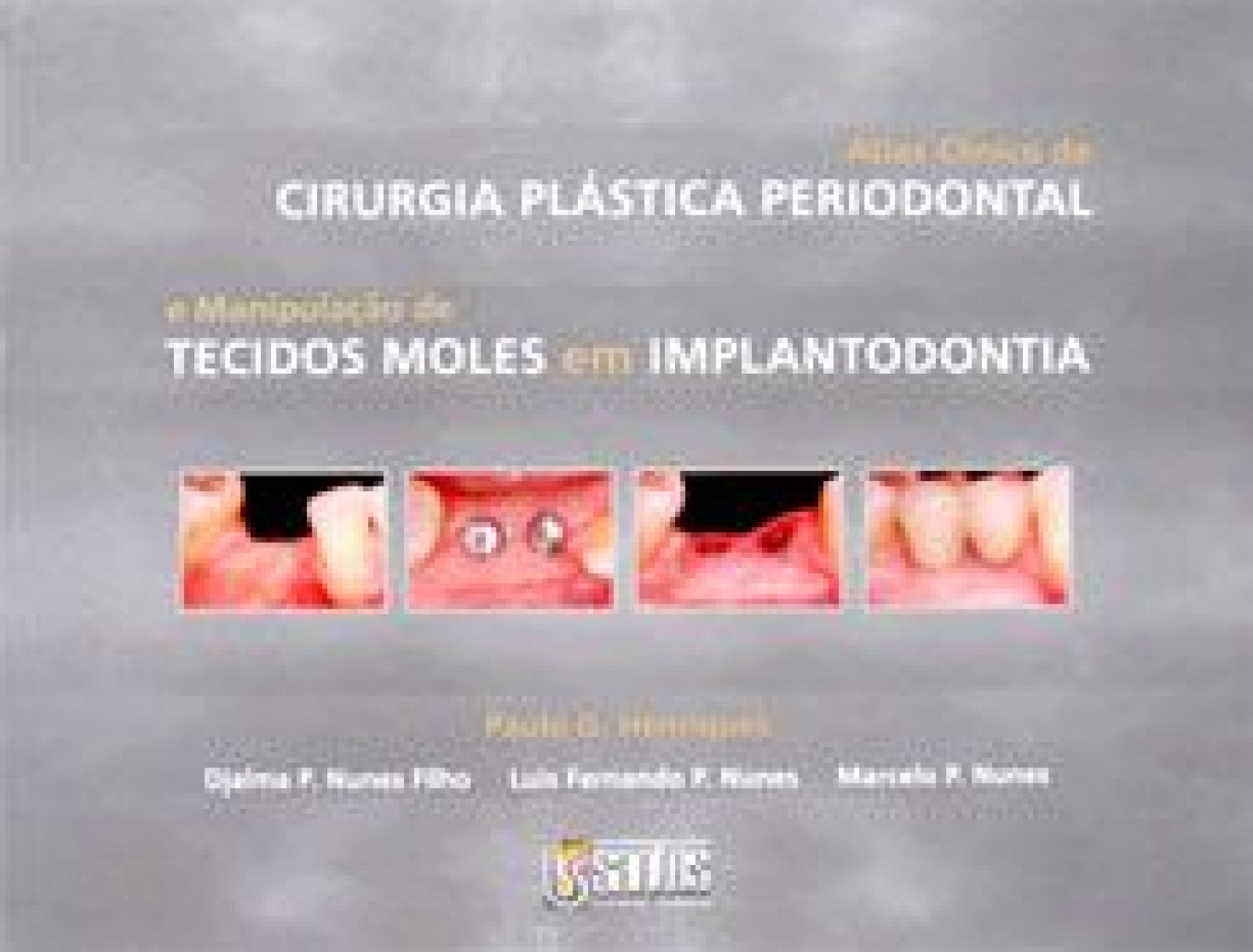 Atlas Clínico De Cirurgia Plástica Periodontal E Manipulação De Tecidos Moles Em Implantodontia