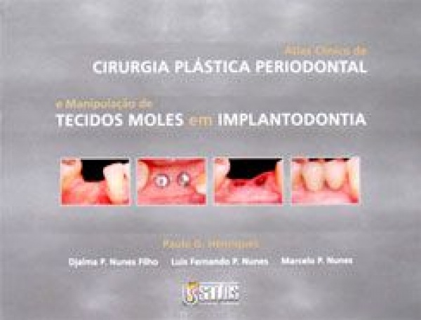 Atlas Clínico De Cirurgia Plástica Periodontal E Manipulação De Tecidos Moles Em Implantodontia