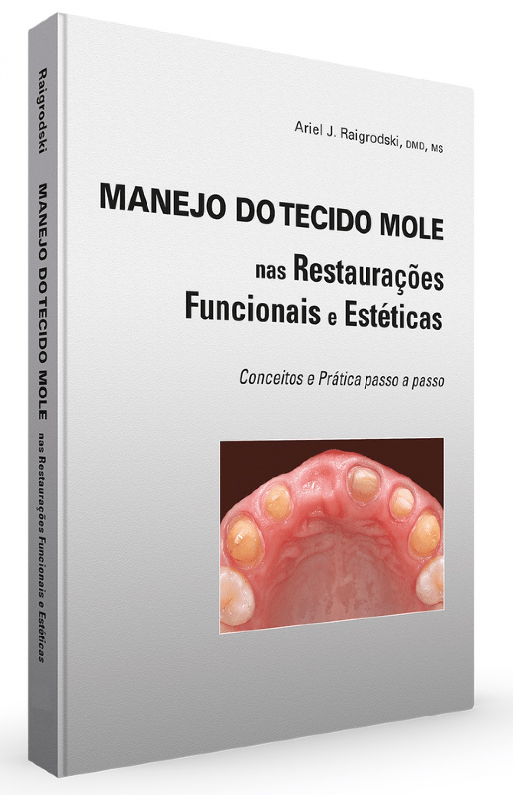 Manejo Do Tecido Mole Nas Restaurações Funcionais E Estéticas