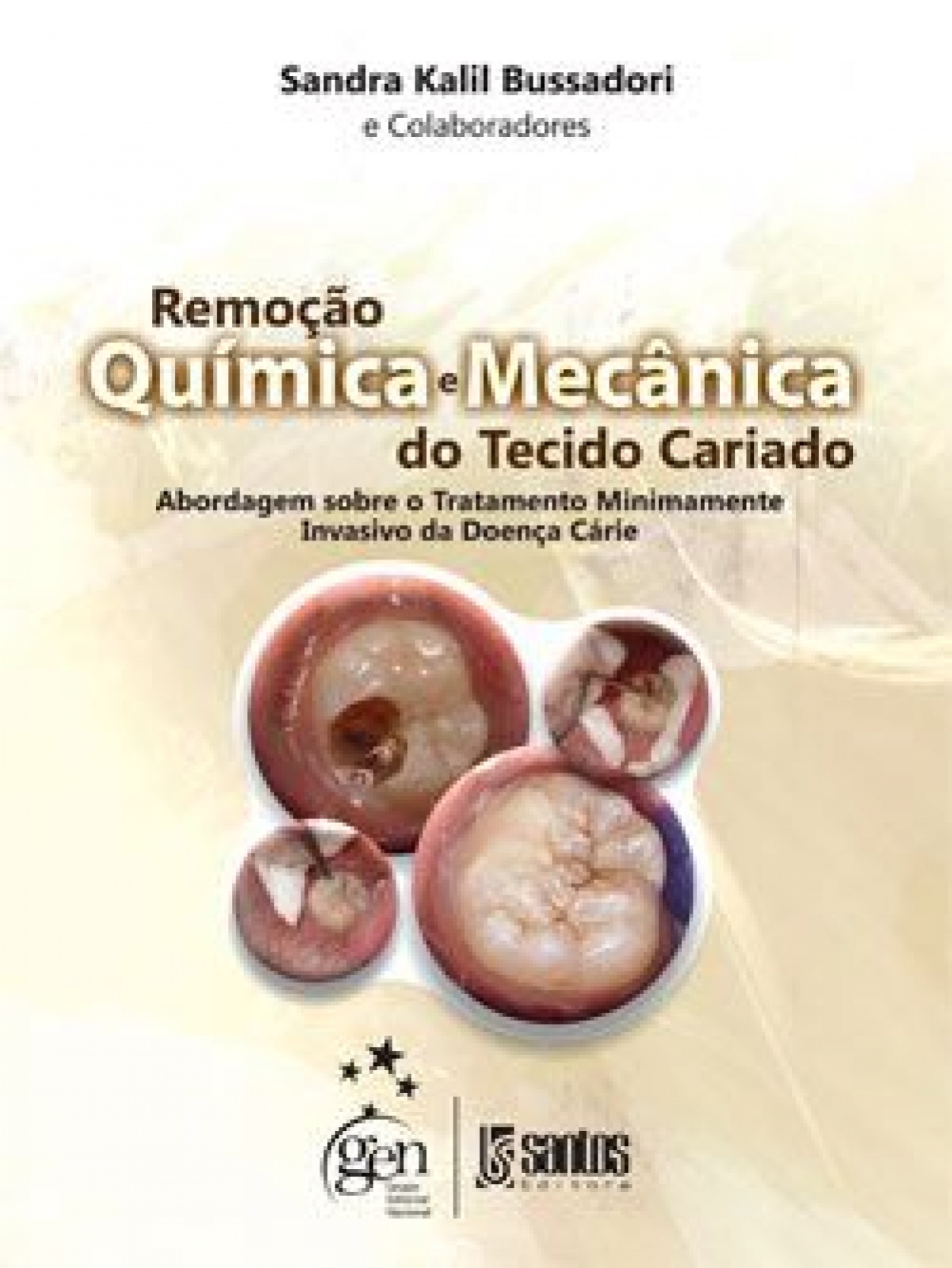 Remoção Química E Mecânica Do Tecido Cariado