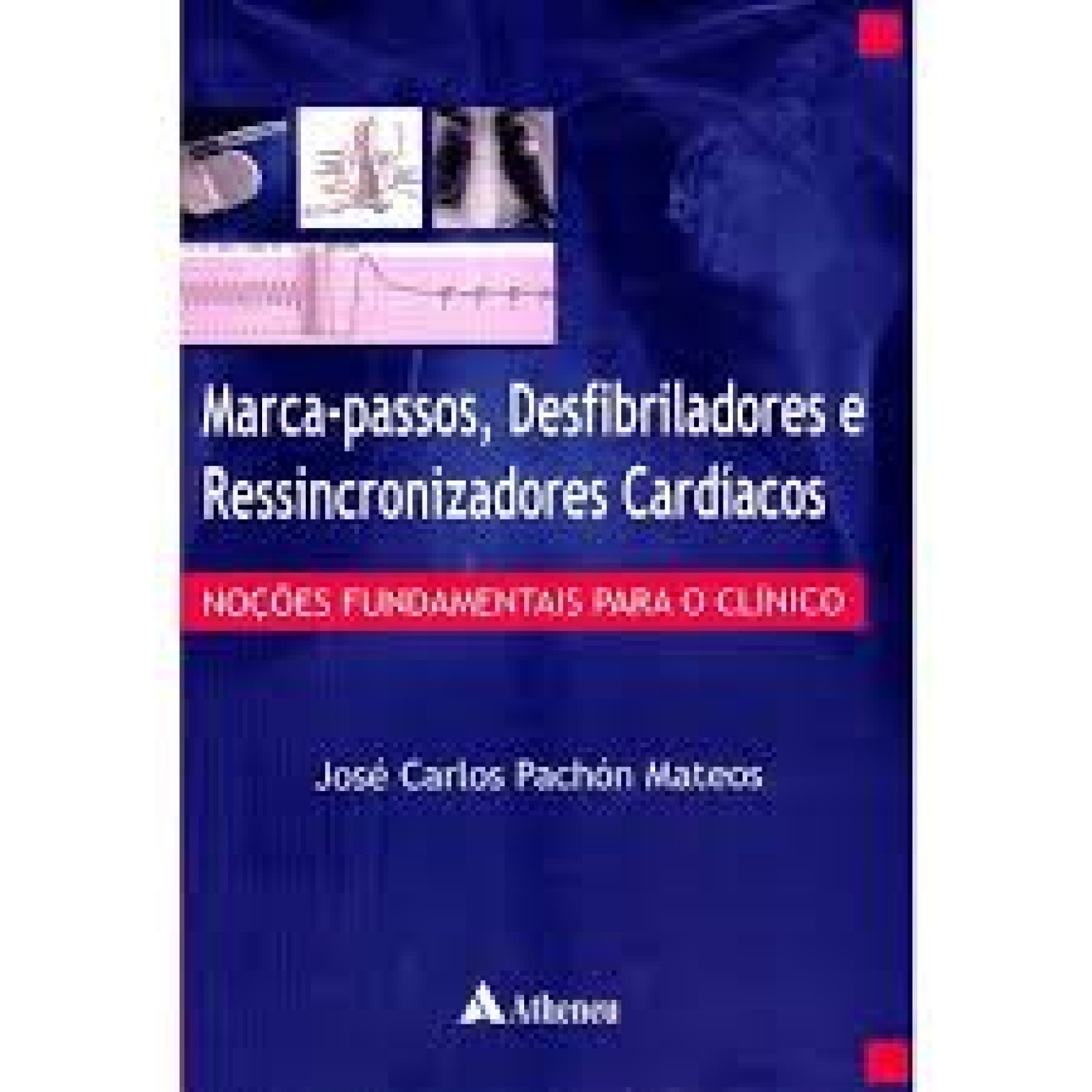 Marca-Passos,desfibriladores E Ressincronizadores Cardíacos - Noções Fundamentais Para O Clínico