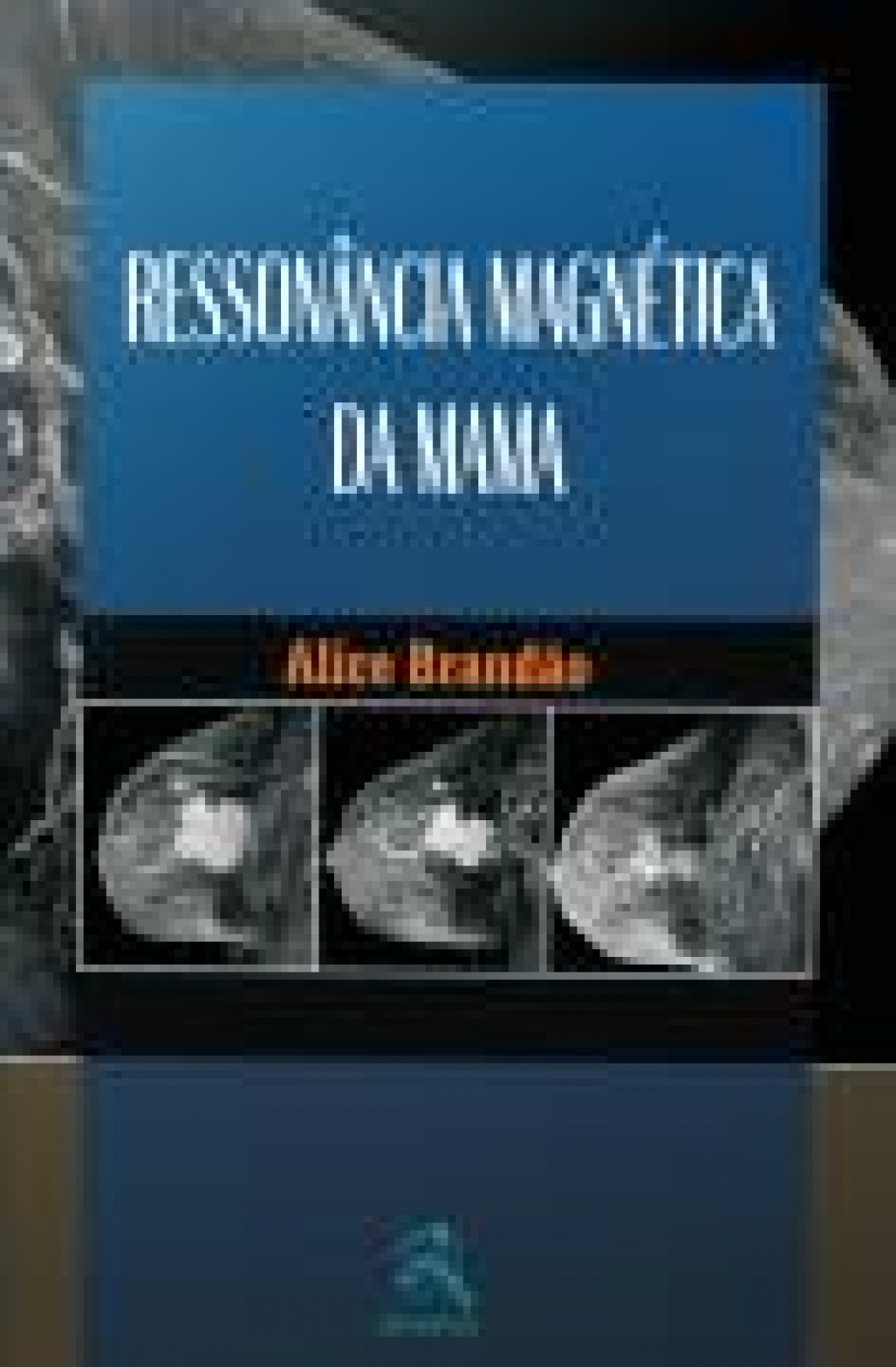 Ressonância Magnética Da Mama