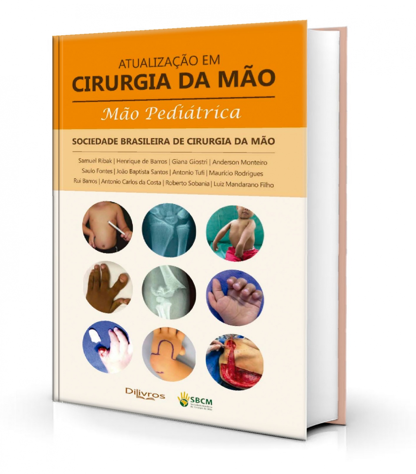 Atualização Em Cirurgia Da Mão - Mão Pediátrica