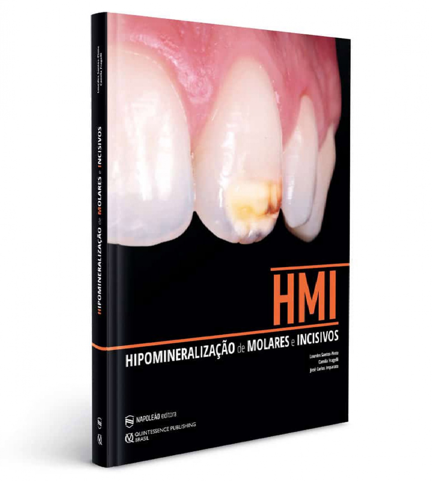 Hipomineralização De Molares E Incisivos
