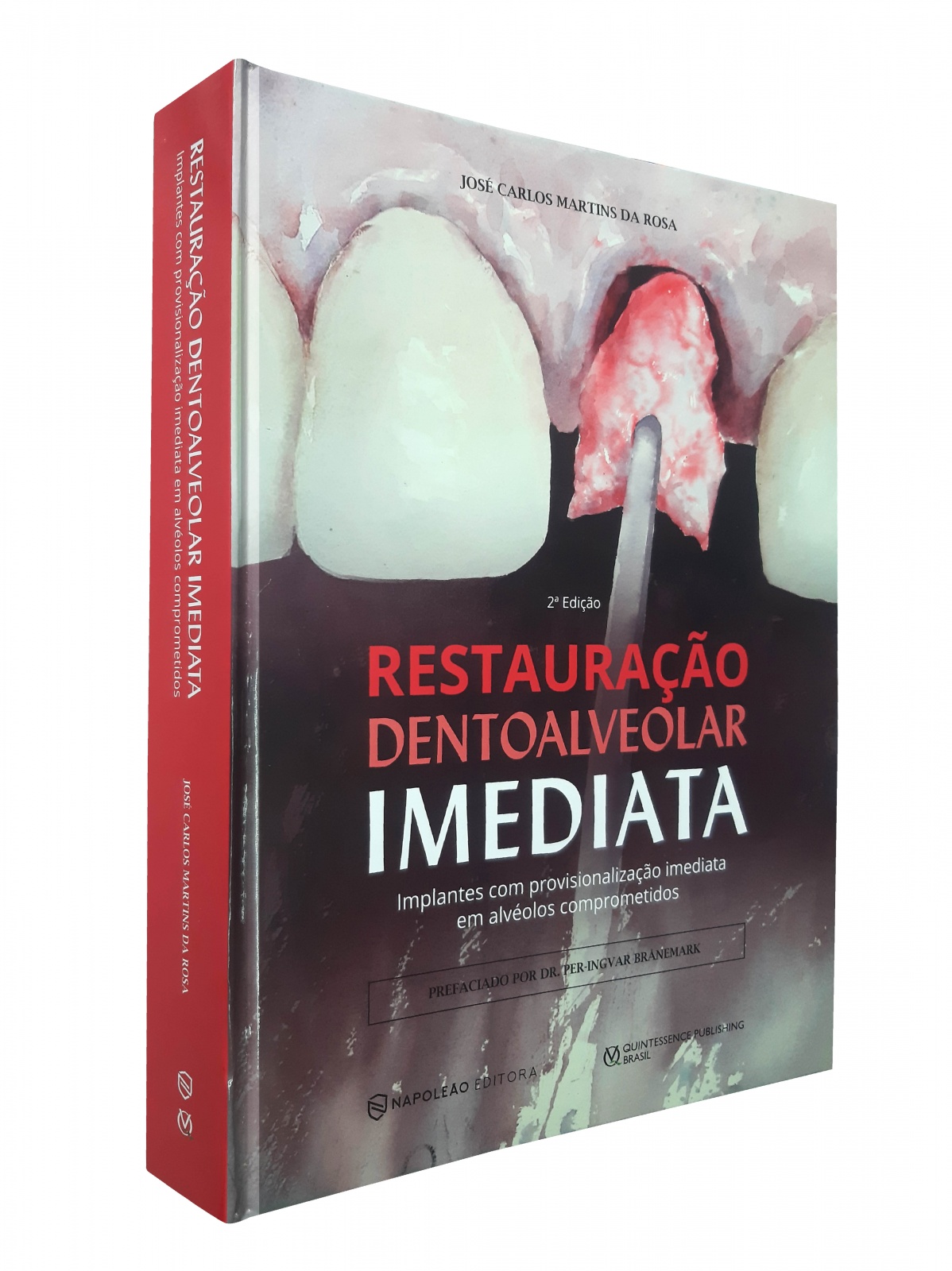 Restauração Dentoalveolar Imediata - Implantes Com Provisionalização Imediata Em Alvéolos Comprometidos