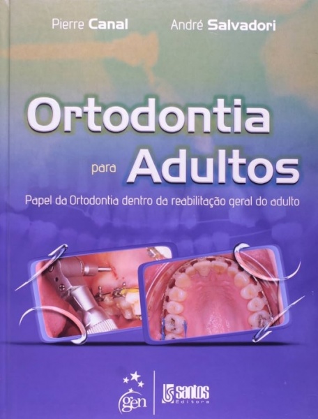 Ortodontia Par Adultos - Papel Da Ortodontia Dentro Da Reabilitação Geral Do Adulto