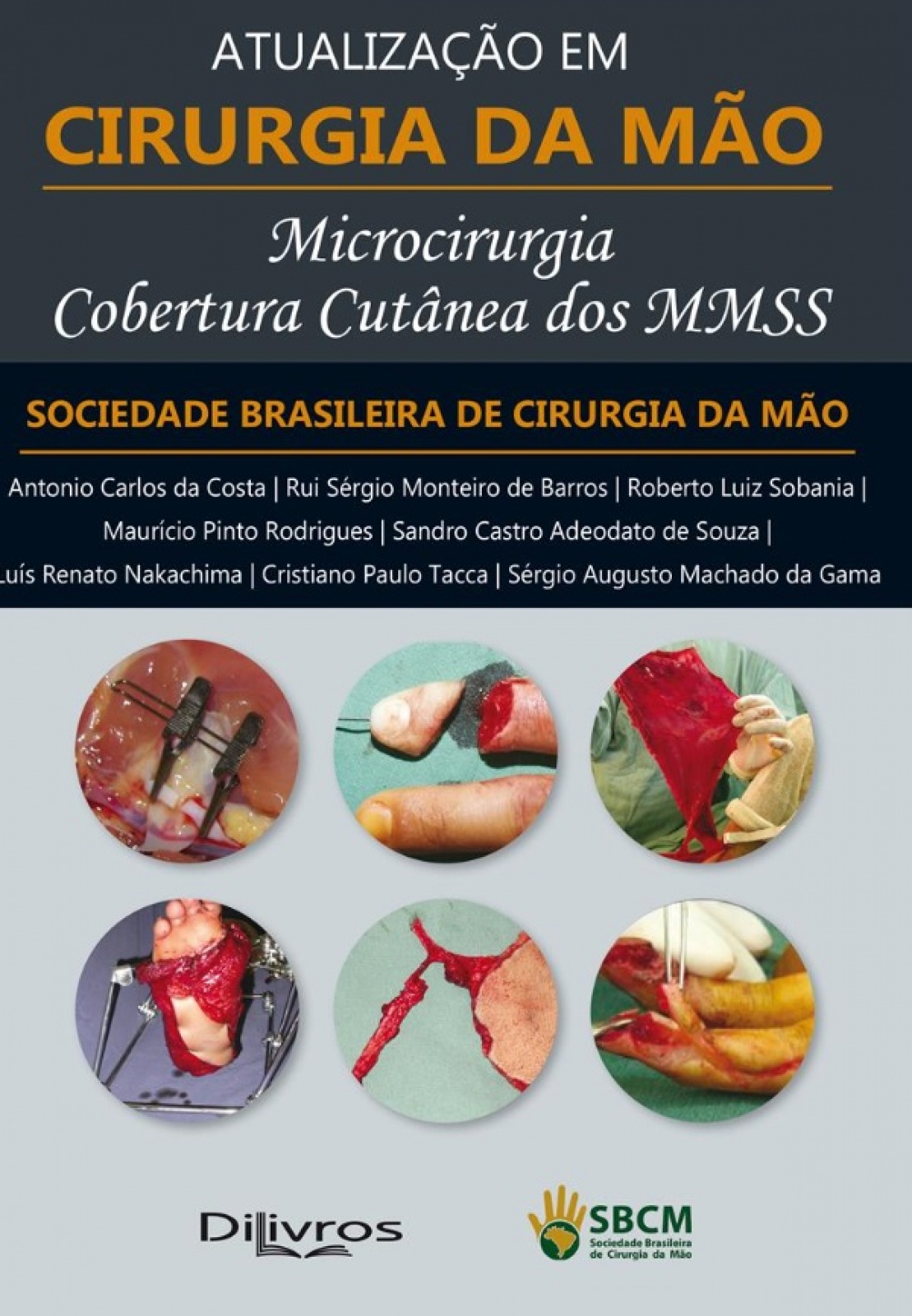 Microcirurgia Cobertura Cutânea Dos Mmss: Atualização Em Cirurgia Da Mão