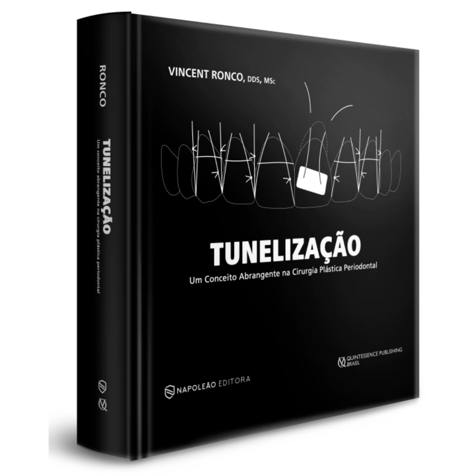 Tunelização Um Conceito Abrangente Em Cirurgia Plástica Periodontal