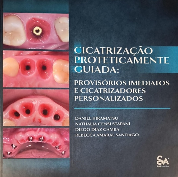 Cicatrização Proteticamente Guiada